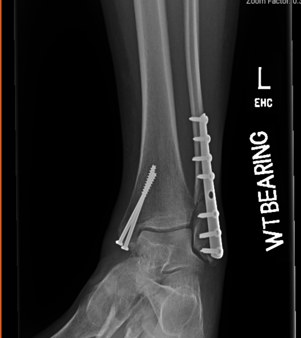 Broken Ankle Weeks 78. 6 weeks after ORIF surgery and 7 weeks… by