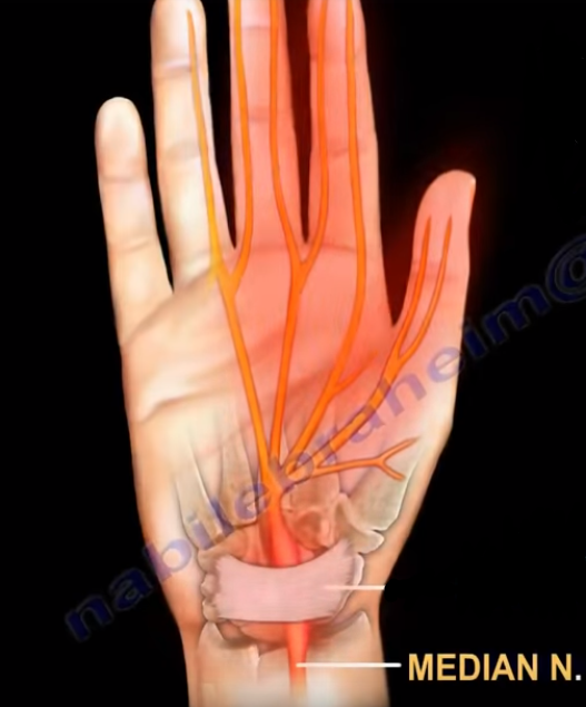 Carpal Tunnel Injection. As the median nerve travels through the… by