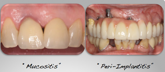 What You Need to Know About Peri-implant Disease | by Izun OralCare |  Healthcare in America