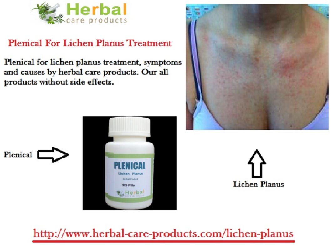 Natural Treatment Of Lichen Planus Effect In Hair Loss By Jennifer Lawrance Medium