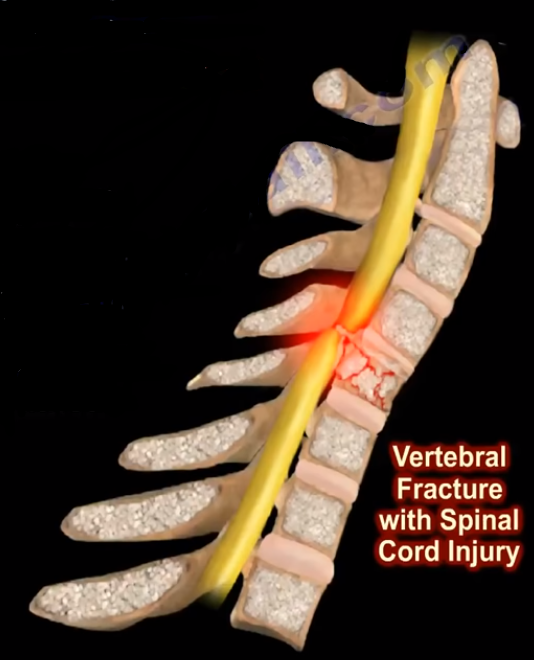 Spinal Cord Injury. Examination and Evaluation of a Patient by Nabil