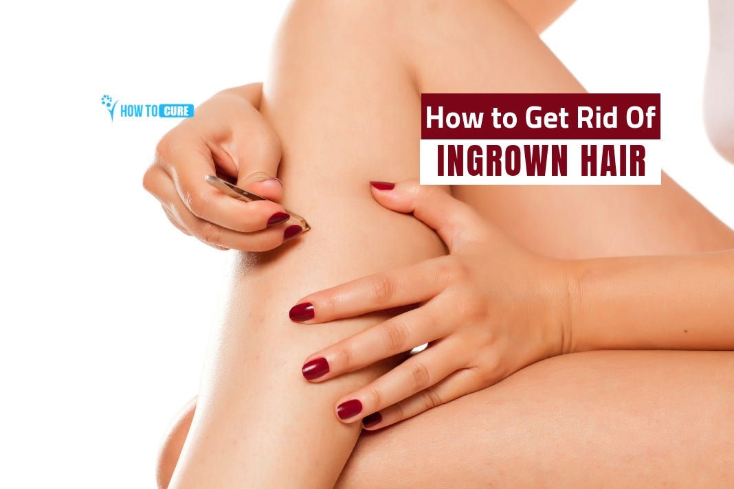 How To Get Rid Of Ingrown Hair With Natural Remedies