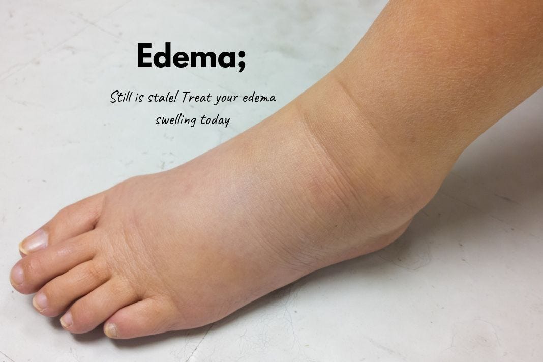Natural remedies to Treat Edema. Painless swelling of the toes or