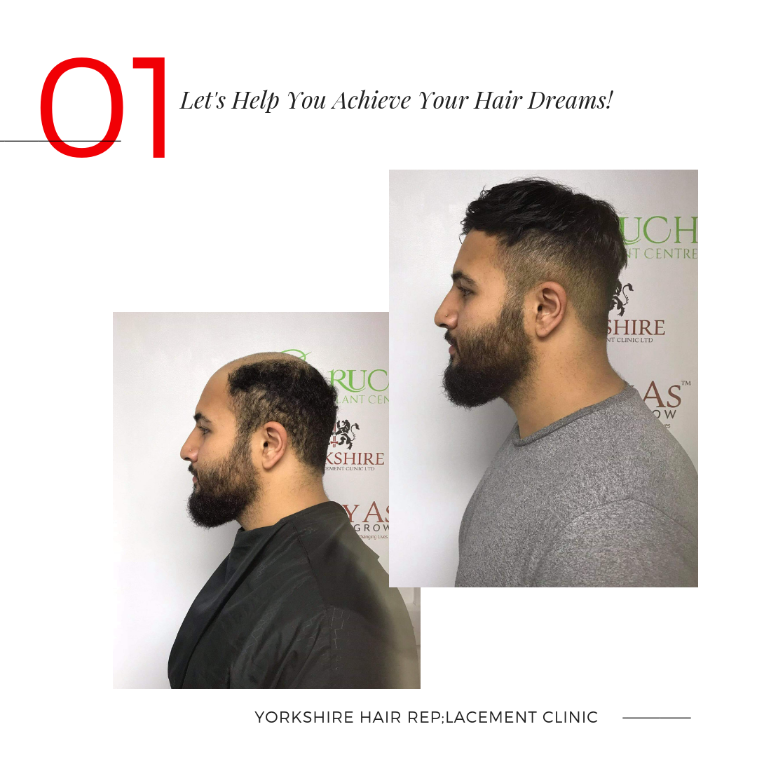 Do You Know About The Symptoms Of Baldness Baruch Hair