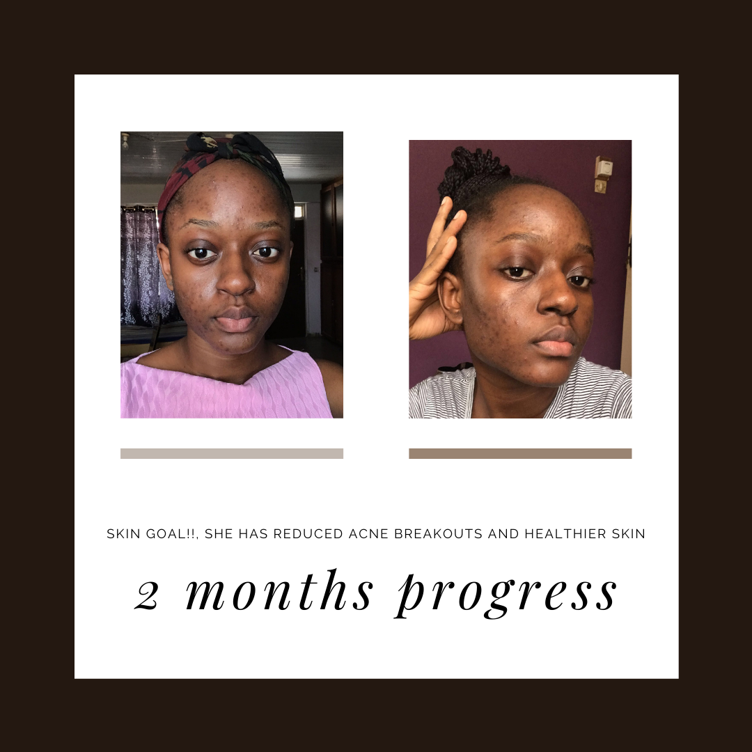 16+ Acne Journey
 Background