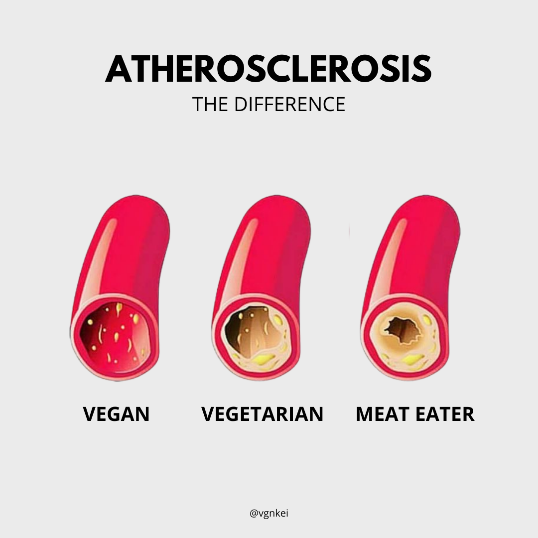 Why Meat Eaters Get Atherosclerosis by Dna kei Medium