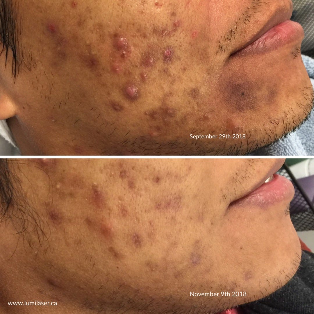 Lighten Up Your Acne Marks And Post Hyperpigmentation By Lumilaser Medium This remedy helps to reduce pimples marks. acne marks and post hyperpigmentation