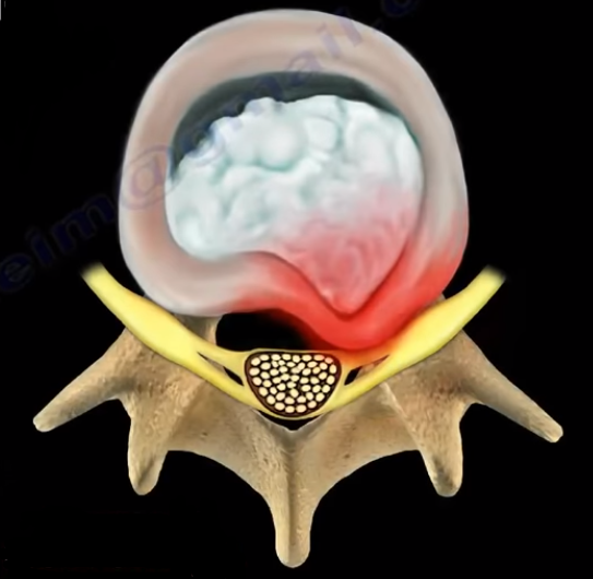 Cauda Equina Syndrome. Cauda equina syndrome is a medical… | by Nabil