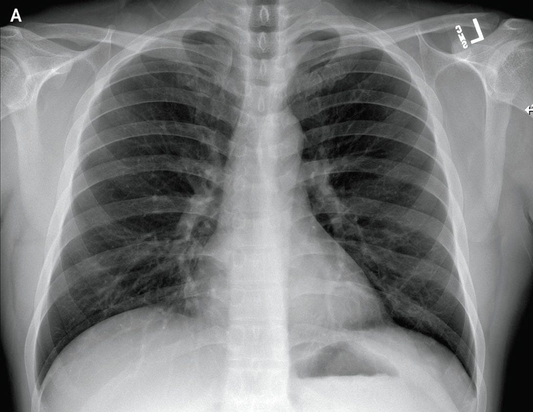 COVID19 XRay Data set — Preprocessing of the data set to