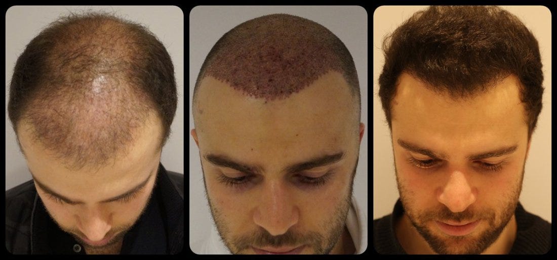 Top 10 Best Hair Transplant in Delhi