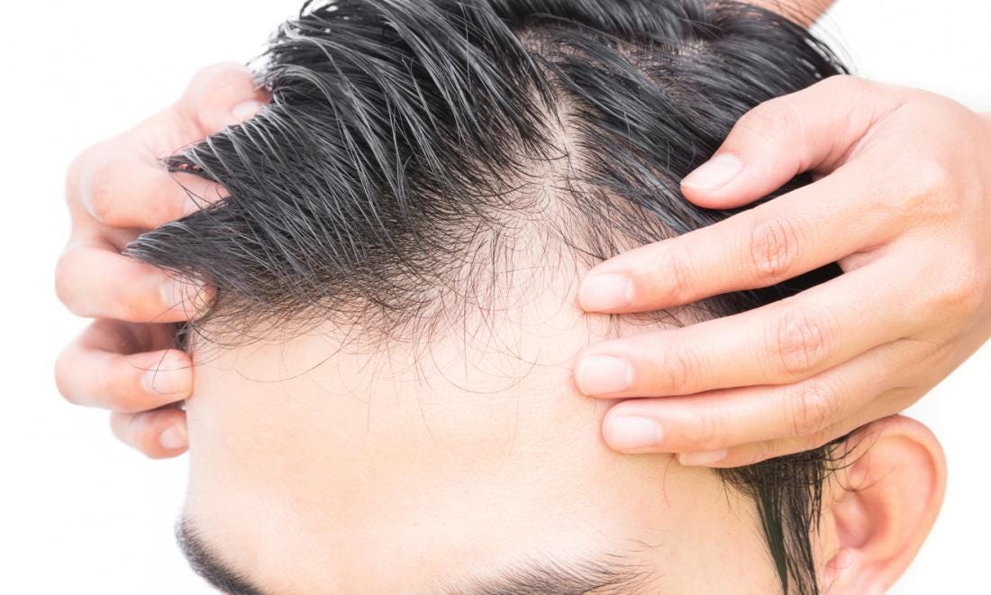 5 Ways To Cure Baldness In Men Milamhealth Medium