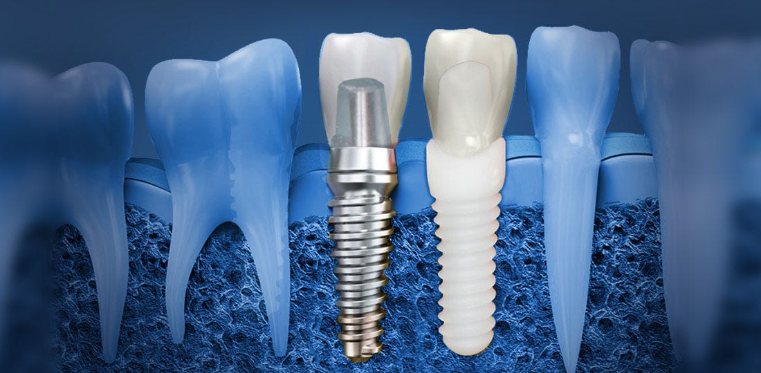 Dental Implant The Methods and The Further Advancements by Captivate