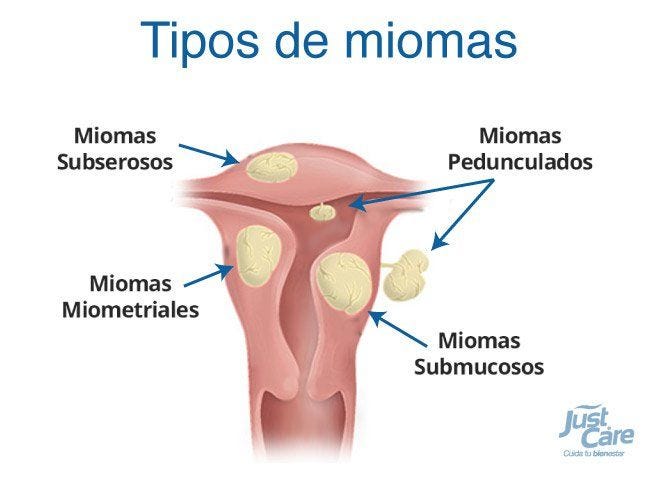 Tipos De Fibroma Uterino Dentro De Los Tipos De Miomas Uterinos By Xiomara Fibromas 4347