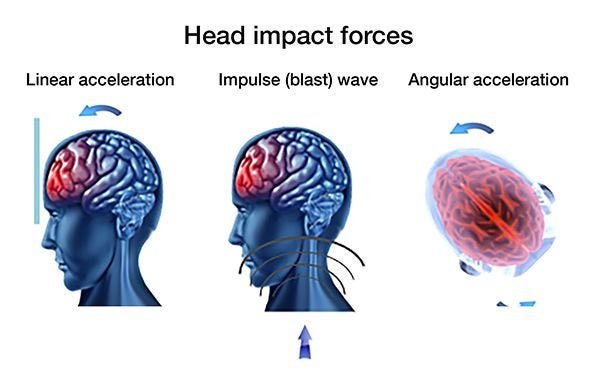 should i sleep after a concussion should i sleep after a concussion