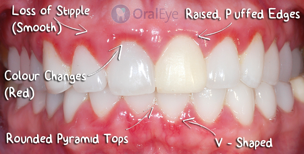 How To Recognize Gum Disease What Do Normal Healthy Gums Look Like
