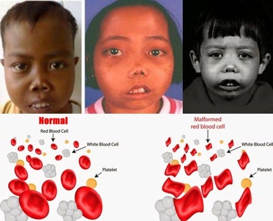 Image result for Penyakit Thalasemia