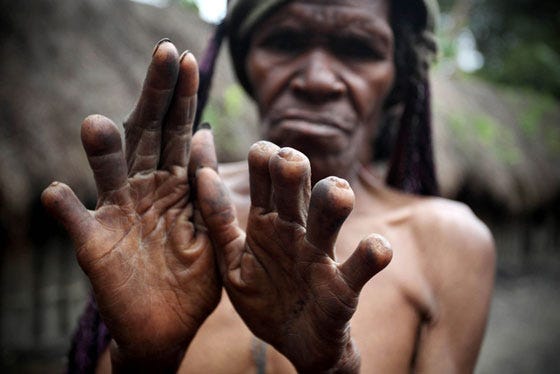 The Horrific Finger Cutting Tradition | The Paradise News 1*mfS3FooFUK2MCHSub9nZjw | The Horrific Finger Cutting Tradition | The Paradise News