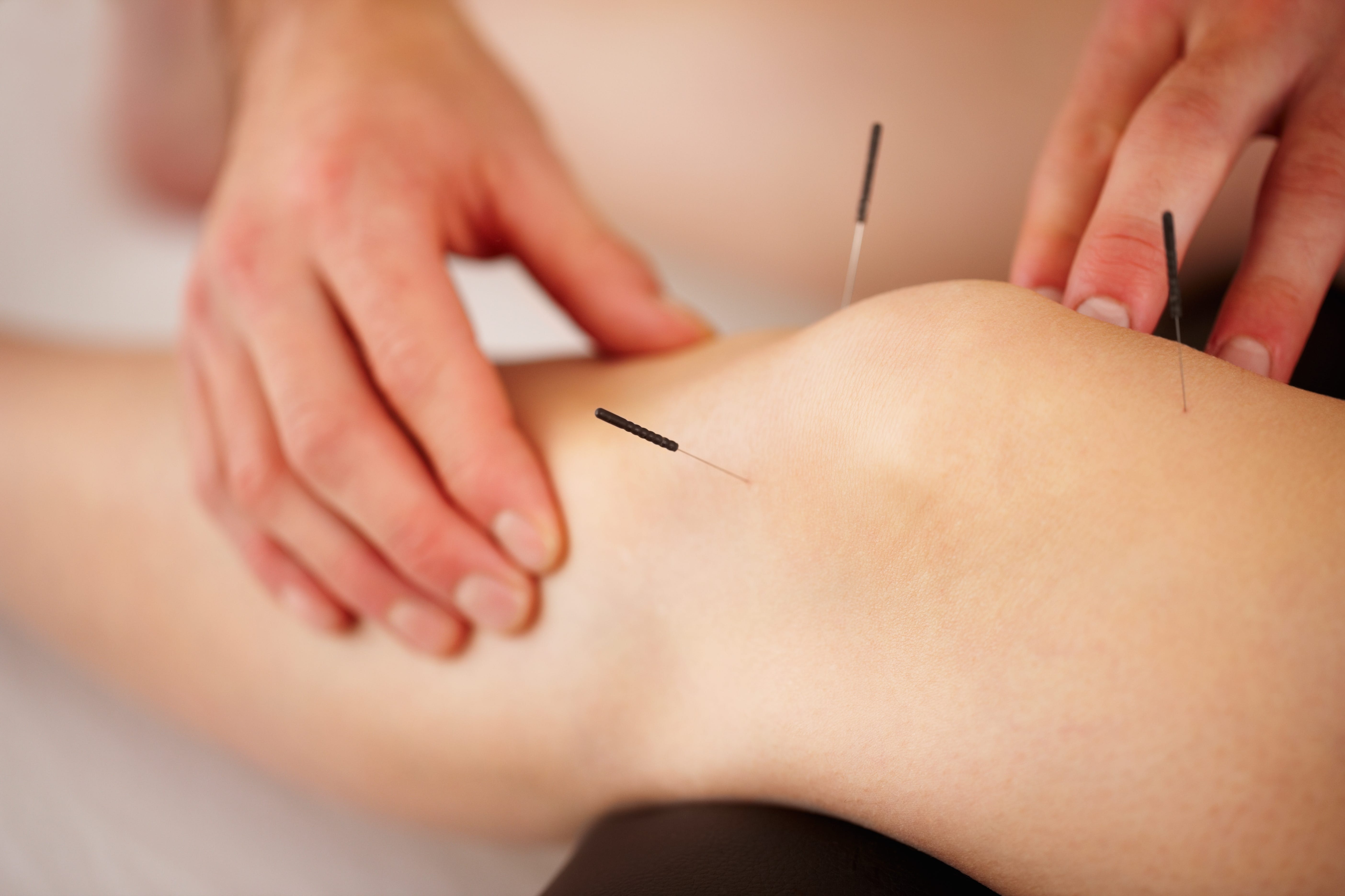 How Acupuncture Saved Me From Unbearable Knee Pain | by Laura Belle | Elemental How Acupuncture Saved Me From Unbearable Knee Pain | by Laura Belle | Elemental