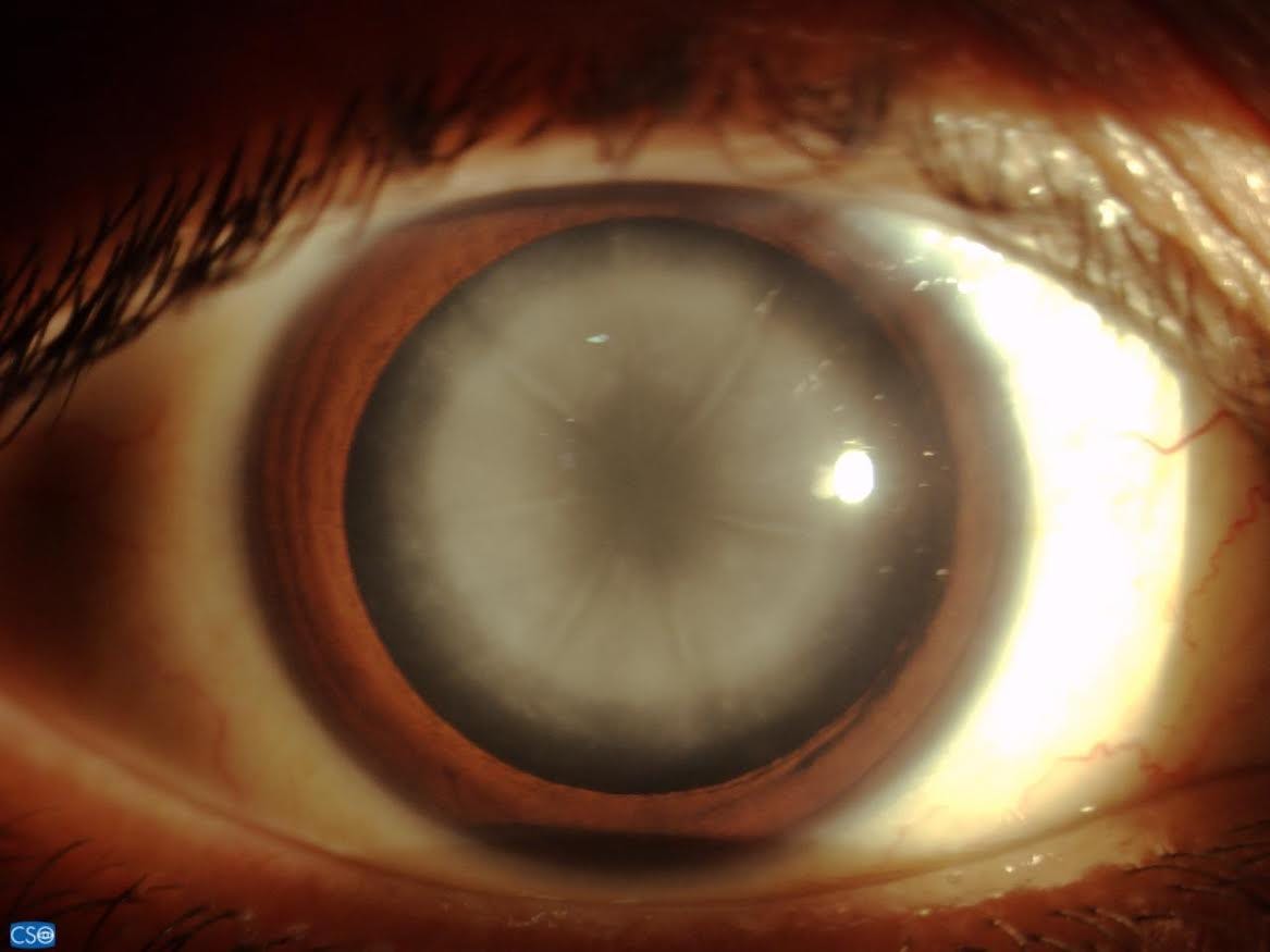 Oh My Cataracts…. At the age of 28, I accidentally found… | by Salam