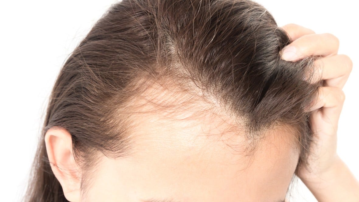 Losing Your Hair In Your 20s Don T Fret Vinayak R S Medium