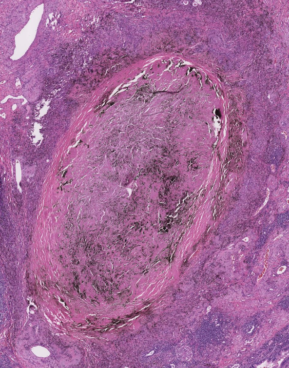 Extra Nodal Marginal Zone Lymphoma With Reed-Sternberg-Like Cells | By ...