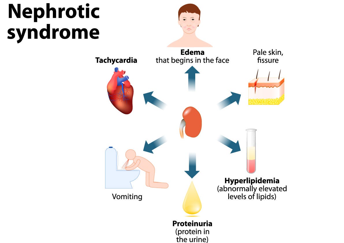 Síndrome hiperglucémico hiperosmolar cetosis