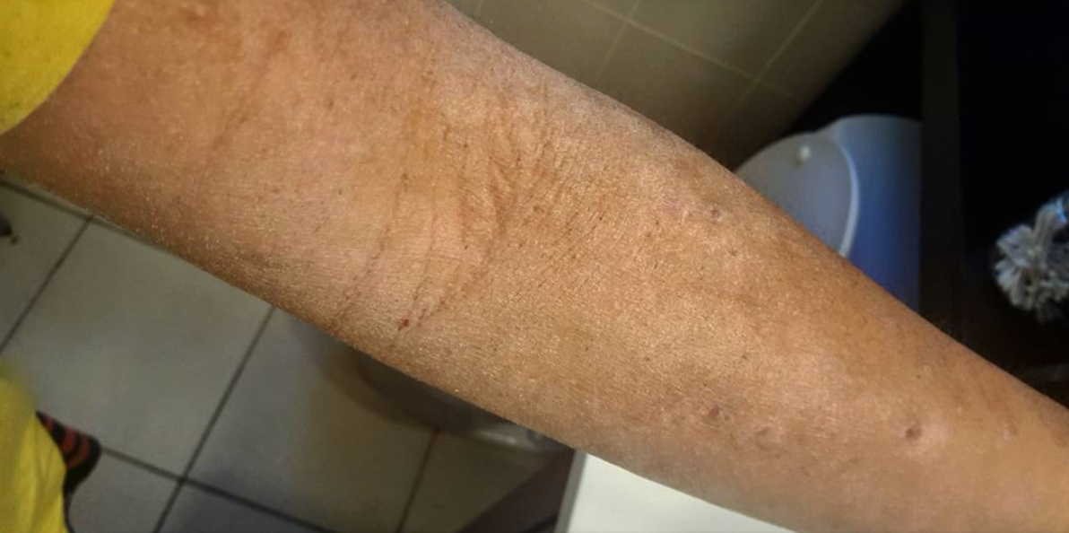 topical steroids, other topicals, and topical steroid ...