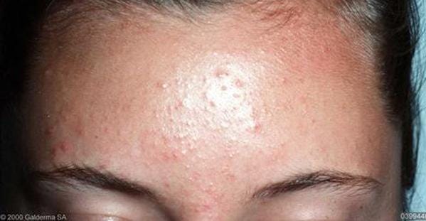 how long does it take to treat fungal acne with nizoral