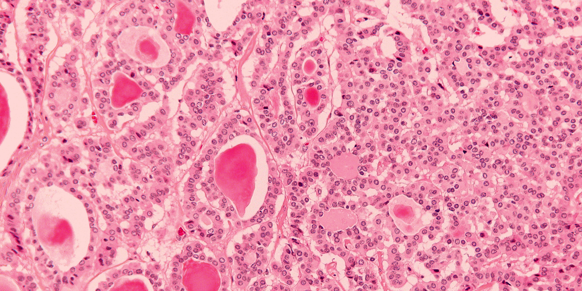 Neuroendocrine tumors. Neuroendocrine tumors are