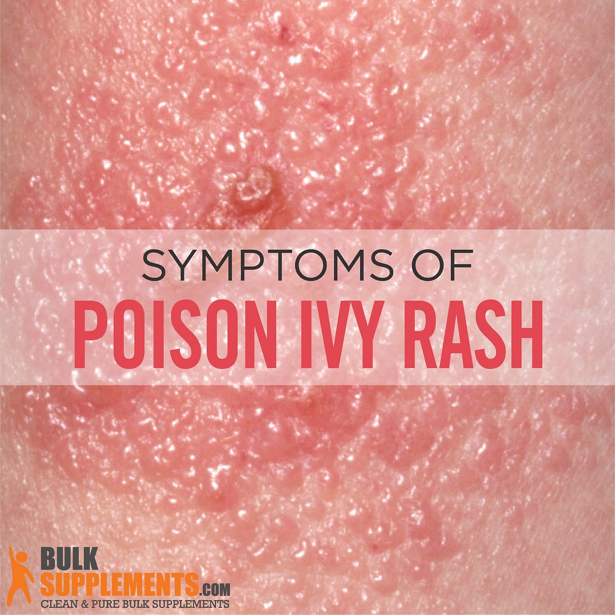 Poison Ivy Rash: Causes, Symptoms & Treatment - James Denlinger - Medium