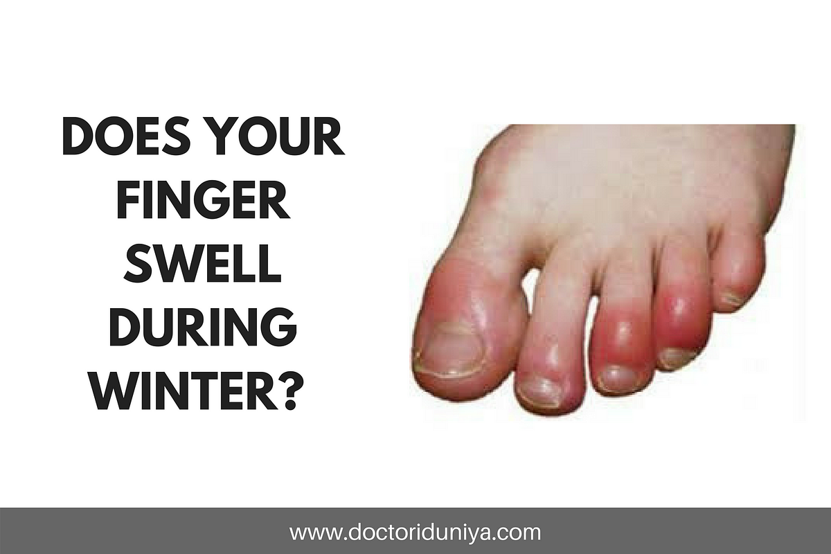 DOES YOUR FINGER SWELL DURING WINTER? KNOW THE REASONS. by