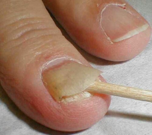 How To Cure Nail Fungus With Vinegar By Nigerian Health Blog Medium