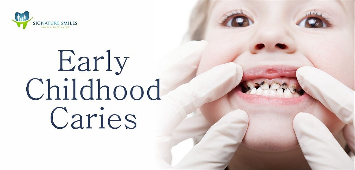 Early Childhood Caries — Causes & Preventions to Take Care of Child’s