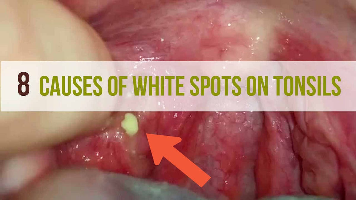 8 Causes of White Spots On Tonsils That You Need to Know | by Sanjeev