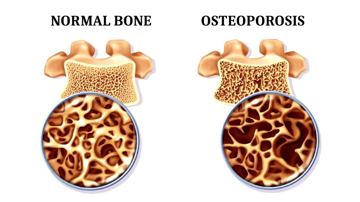 What is Osteoporosis or Osteopenia and what do you need to know? by