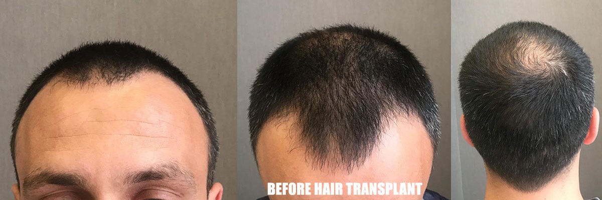 Hair Transplant Clinic UK - Hair Replacement Surgery - HRBR