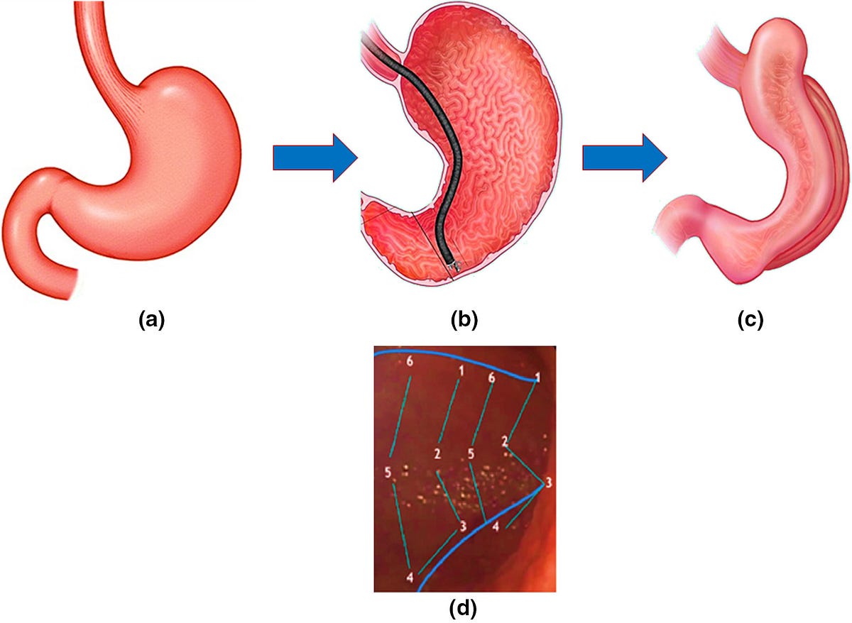 Laparoscopic Sleeve Gastrectomy (LSG) vs Endoscopic Sleeve