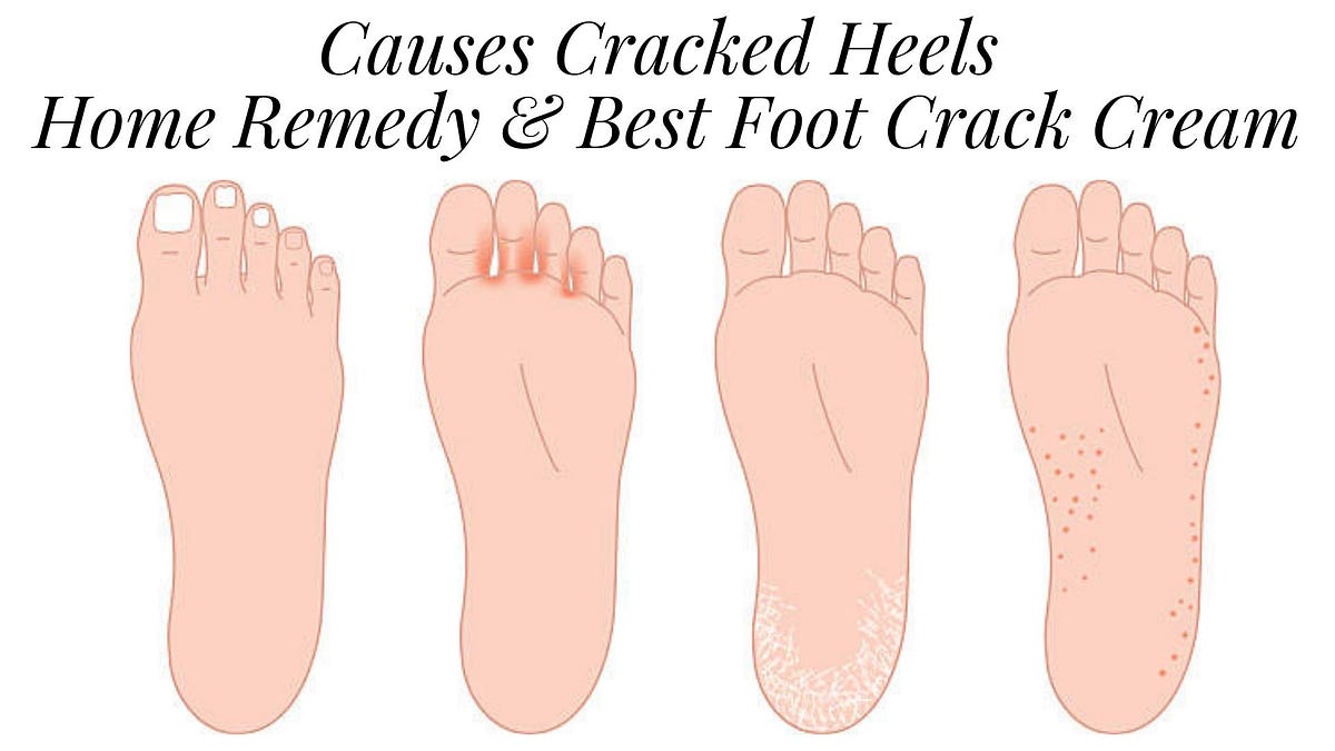 cream for ankle cracks