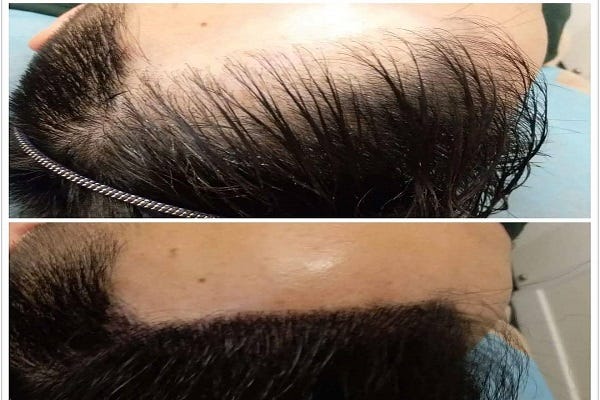 How Hair Loss In Men And Women Can Be Treated With Scalp
