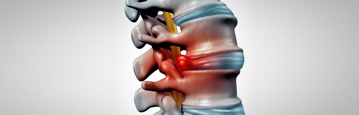 Epidural Steroid Injections Pros And Cons By North Shore Pain Management Medium
