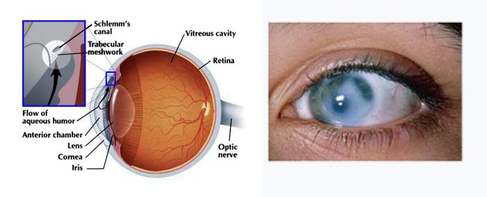Obat Herbal Untuk Penyakit Mata Glaukoma Terkait Mata