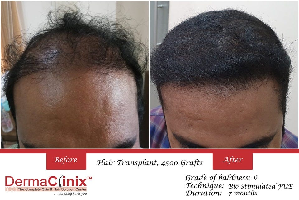 Hair Transplantation At 0 Risk Free At Best Hair Transplant