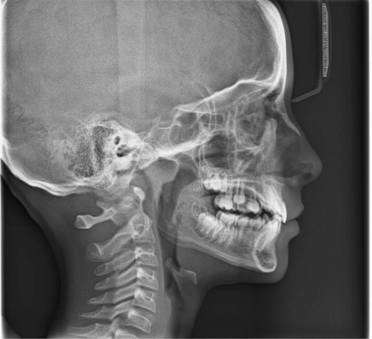 ¿Qué nos dice una radiografía panorámica? by