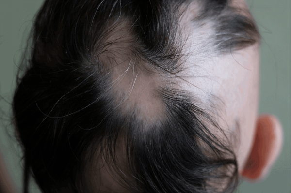 How Alopecia Stopped My Depression Lady Alopecia Medium