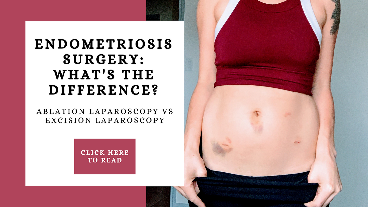 Endometriosis Surgery Ablation Laparoscopy Vs Excision Laparoscopy What Is The Difference 4375