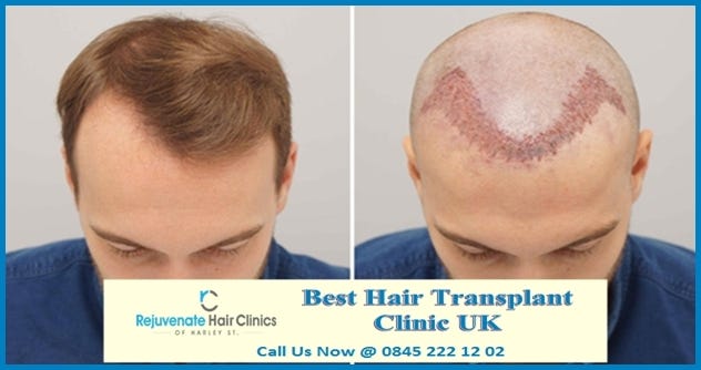 Dhi Direct Hair Implant Hair Transplant Choi Pen Hair
