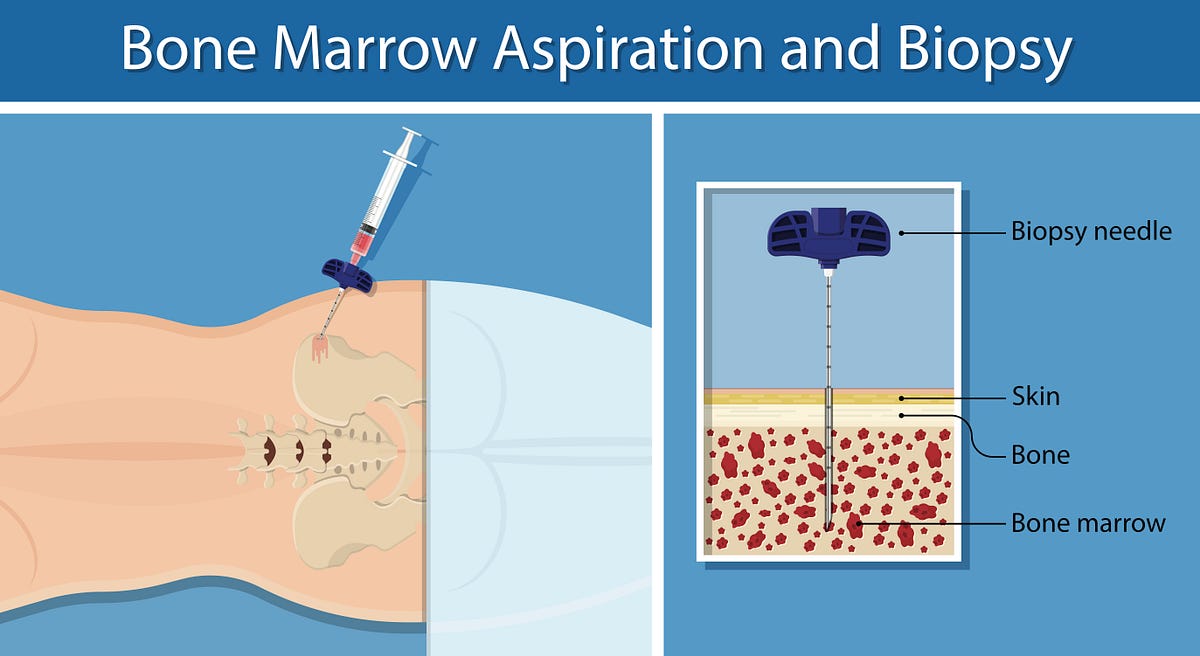Improving Patient Experience During Bone Marrow Biopsies by The DICE