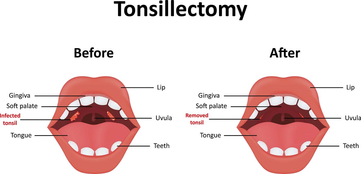 Coblation Tonsillectomy to Stop Snoring by Stella maxwell Medium