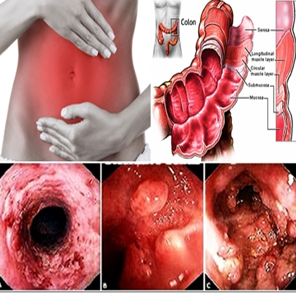 Obat Radang Usus Besar — 12 Jari dan Lambung | by Obat Radang Usus