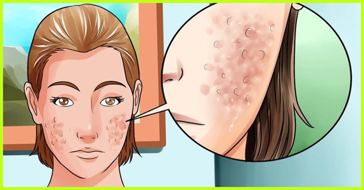 effective remedy for pimple marks